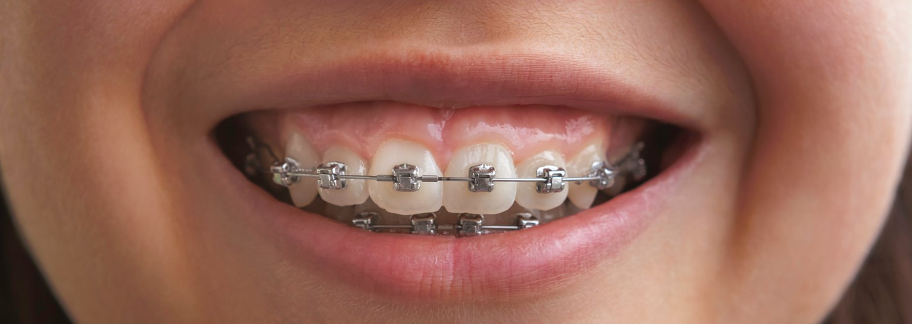 Braces facility provided by Green Orthodontics, Columbia, SC