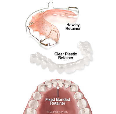 Post-Orthodontic Care | Green Orthodontics Retainers