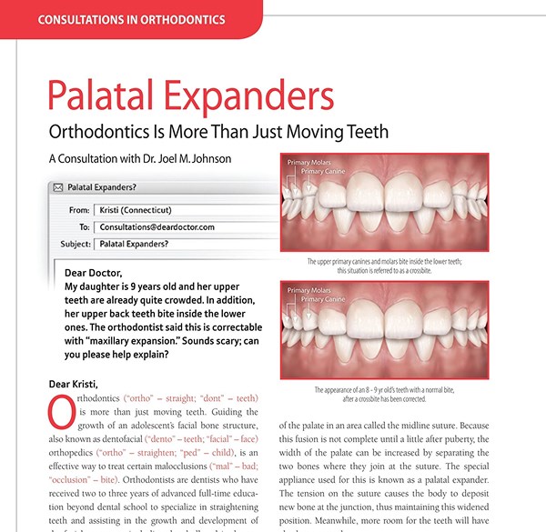How To Expand Palate Expander